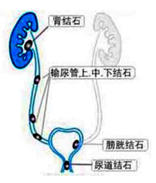 输尿管结石的主要症状