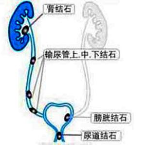 输尿管结石有哪些症状