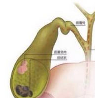 膀胱结石会诱发癌变吗